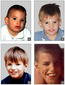 Clinical features of a patient with Cri du Chat syndrome at age of 8 months (A), 2 years (B), 4 years (C) and 9 years 6/12 (D)